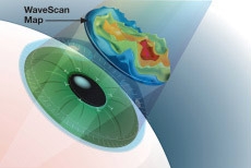 LASIK Eye Surgery: Everything You Need to Know