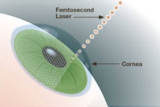 LASIK Eye Surgery: Everything You Need to Know