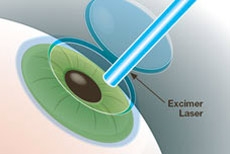 LASIK Eye Surgery: Everything You Need to Know