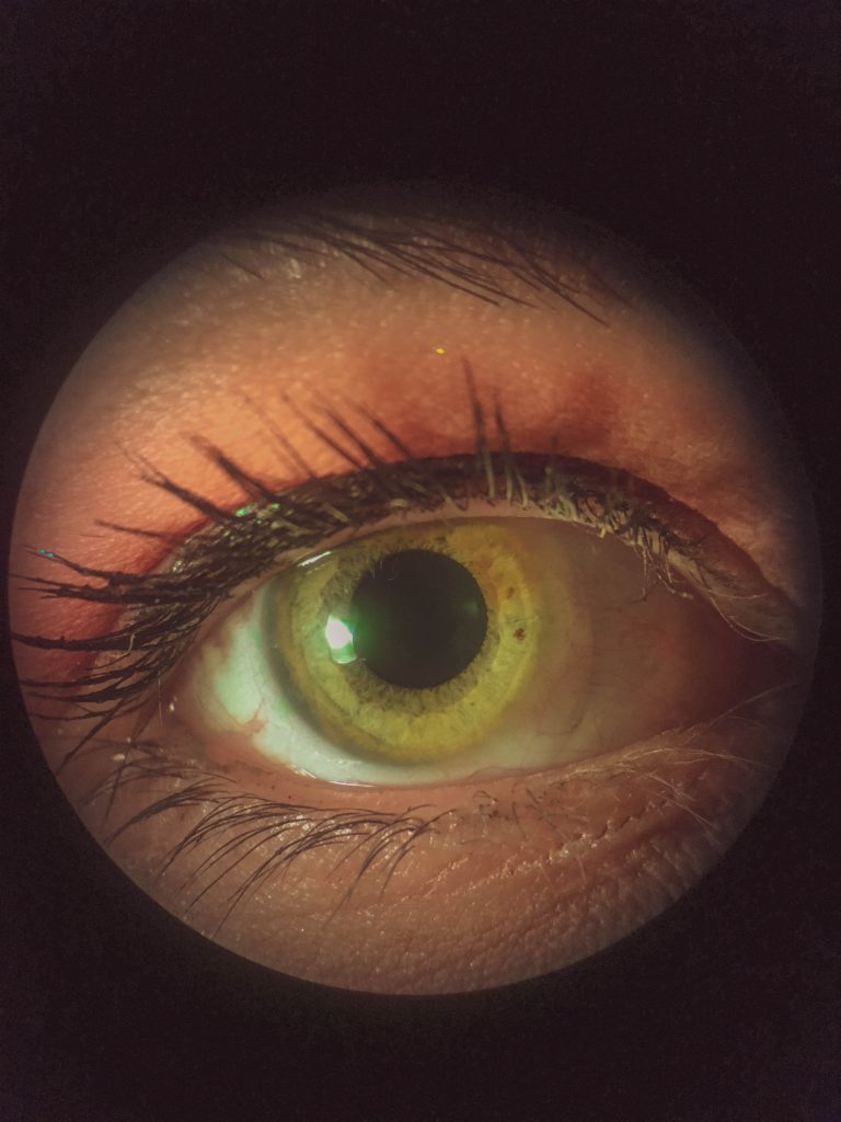 LASIK Eye Surgery
